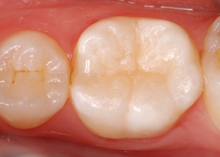 虫歯治療　CR（コンポジットレジン）について